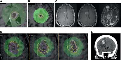 Biopsy Artifact in Laser Interstitial Thermal Therapy: A Technical Note